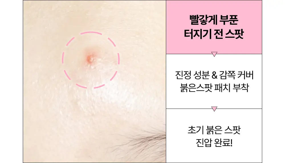 [올영단독] 해서린 스팟케어 패치 단품 (붉은스팟, 노란스팟) 상세페이지 12